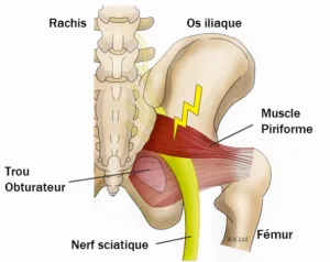 traitement sciatique ostéopathie nerf lombaire